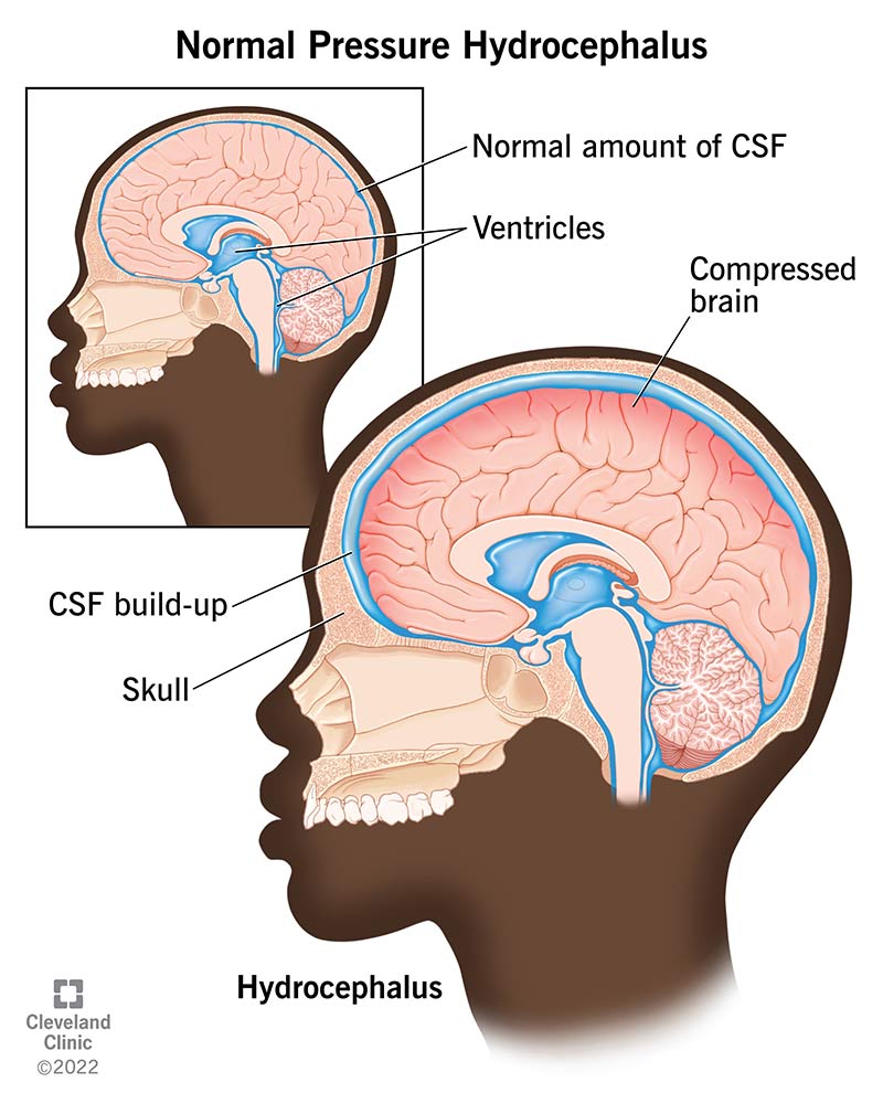 Slow cerebrospinal fluid (CSF) buildup puts pressure on the brain and causes normal pressure hydrocephalus.