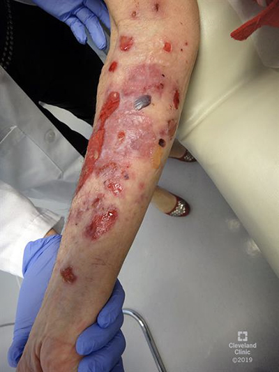 Bullous pemphigoid welts on a person’s arm.