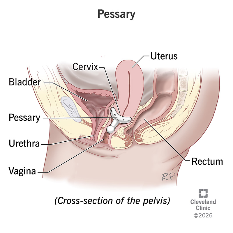A pessary holding the uterus in place