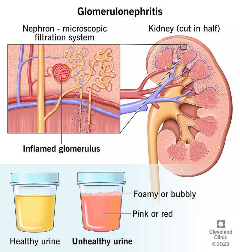 Inflamed glomeruli inside a human kidney next to samples of healthy and unhealthy pee showing color and appearance differences.