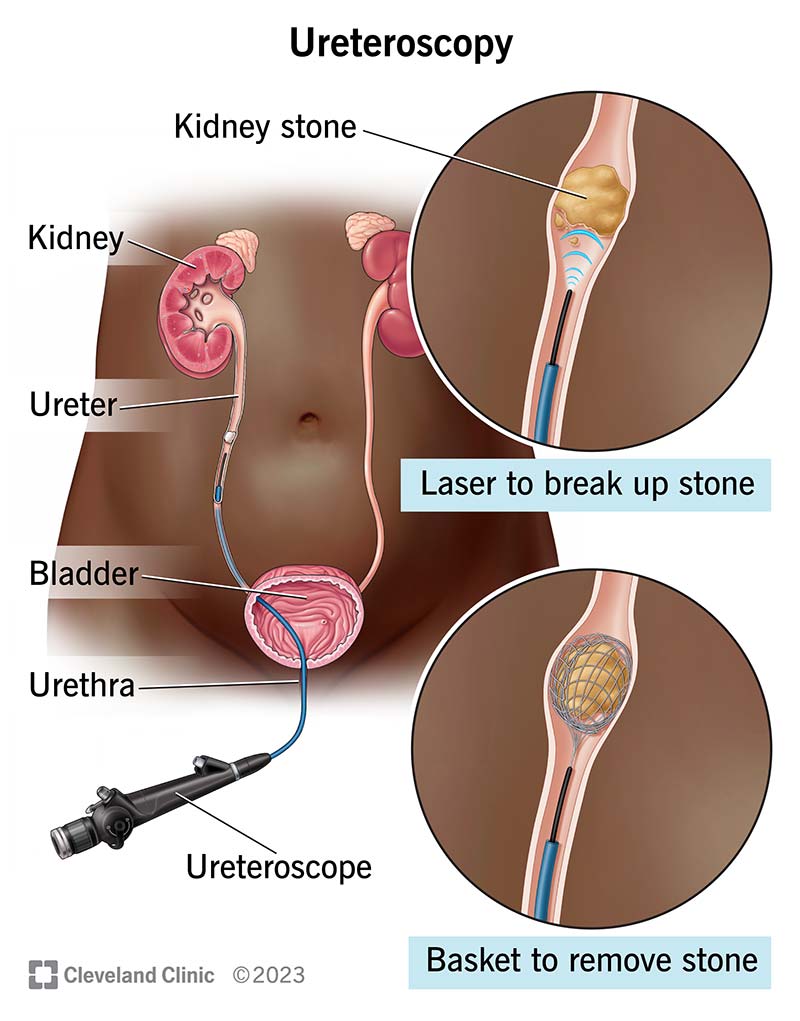 A ureteroscope passing through urethra, bladder and ureter to the kidney to break up or remove stone
