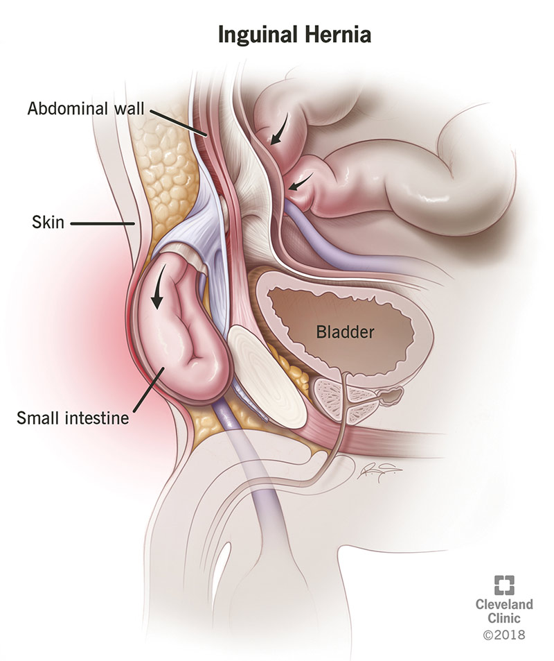 A portion of the small intestine has slipped through the abdominal wall, called an inguinal hernia. This creates a bulge under the skin.