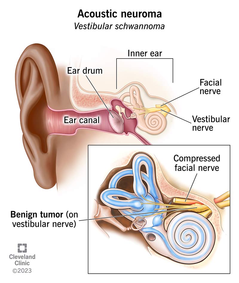 An inner ear with facial and vestibular nerve; and benign tumor on vestibular nerve below compressed facial nerve.