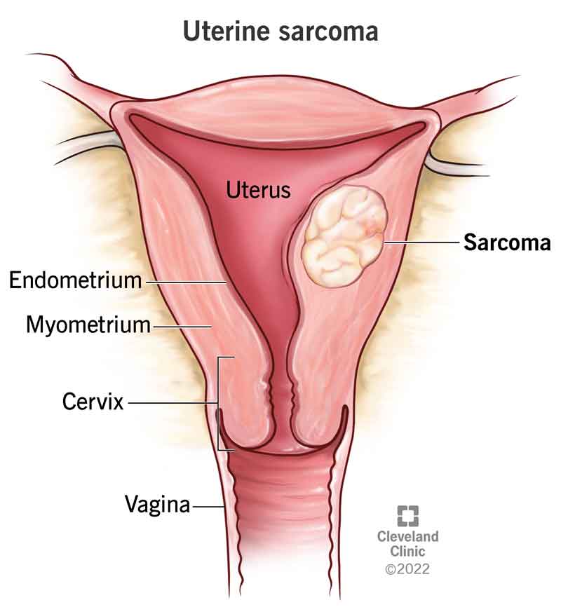 Sarcoma developing in the muscle wall of the uterus.