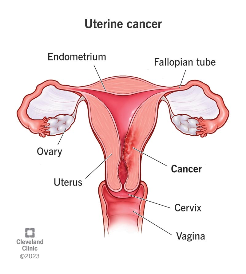 Location of uterine cancer in the uterine cavity.