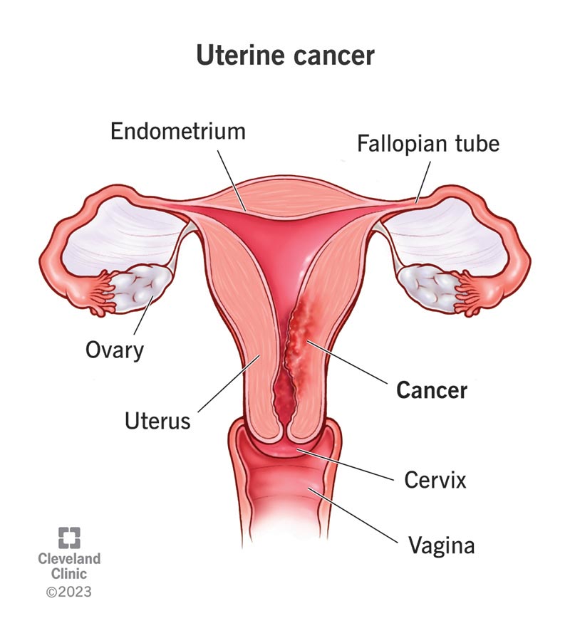 Uterine Cancer Endometrial Cancer Symptoms Treatment