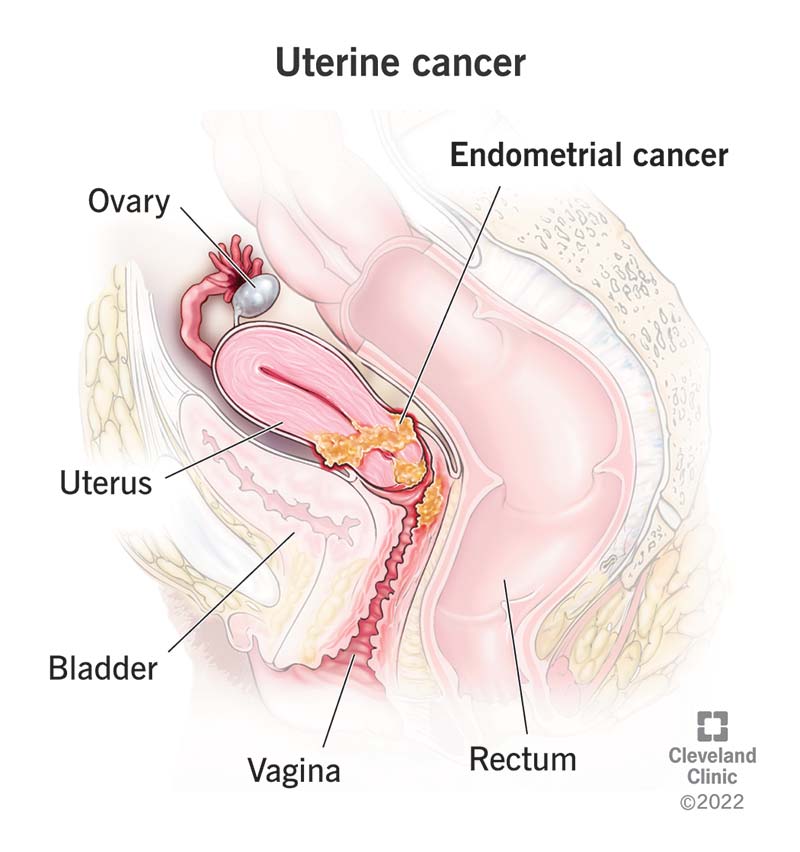 Endometrial cancer that’s formed in the bottom portion of the uterus