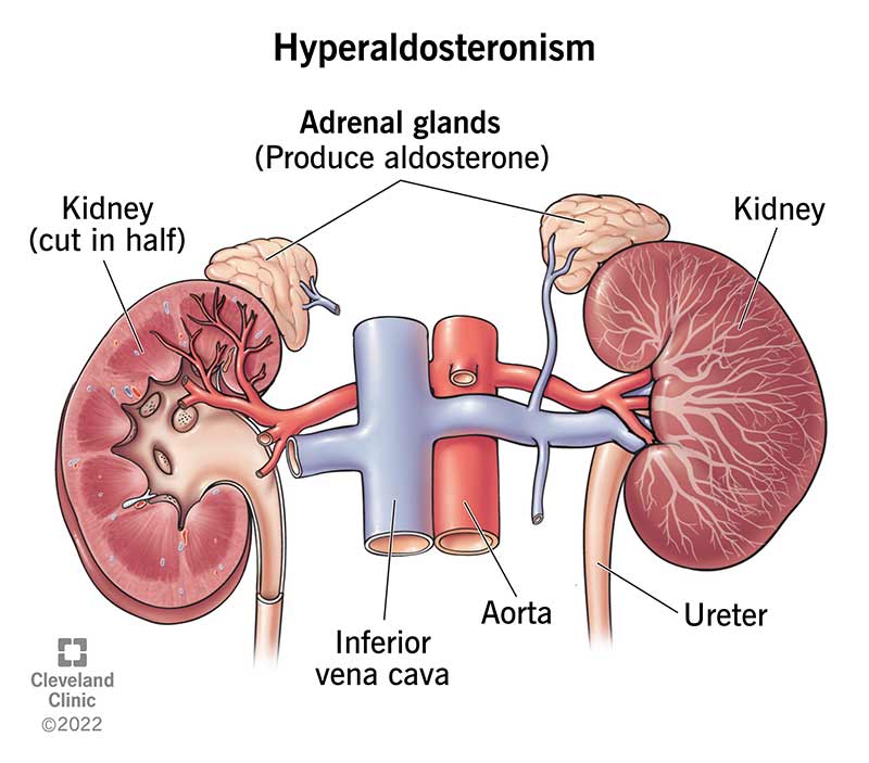 Medical illustration of two kidneys with one triangle-shaped adrenal gland on top of each of them.