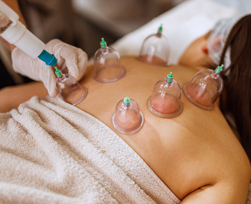 Provider placing cups on person’s back during cupping therapy.