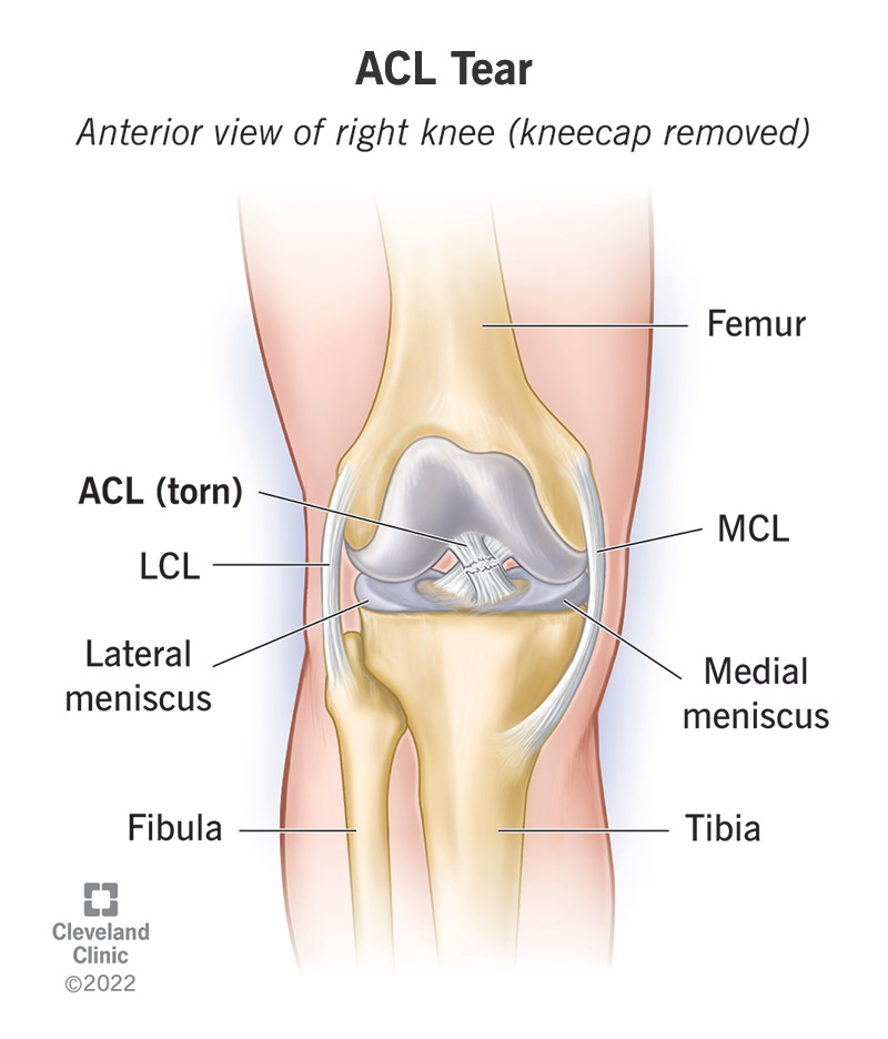 An illustration of a torn ACL inside a knee