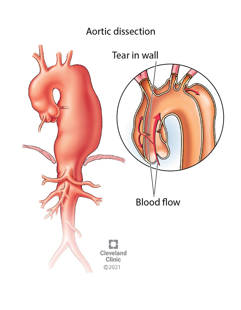 Aortic dissection is a tear in the inner layer of the aortic wall. Blood pours through the tear, causing a separation between the wall layers, a bulge in the artery’s appearance and weakness in that area of the aorta.