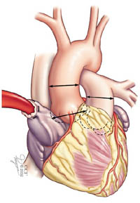 Medical drawing indicating where your surgeon measures your aortic and pulmonic valves in the Ross procedure.