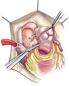 Medical illustration showing inspection of the valves as part of the Ross procedure.