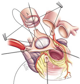 Medical illustration showing how the aortic and pulmonary valves are switched in the Ross procedure.