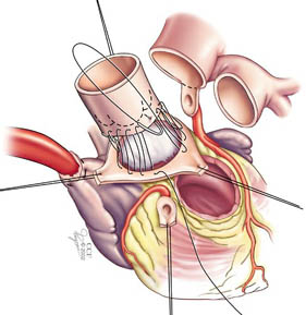 Illustration shows how the coronary arteries are reattached as part of the Ross procedure.