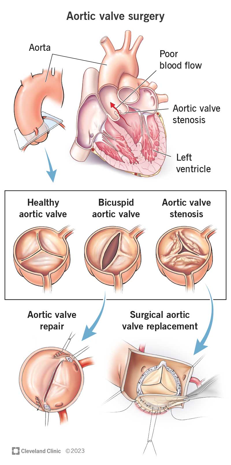 Aortic valve repair and replacement.