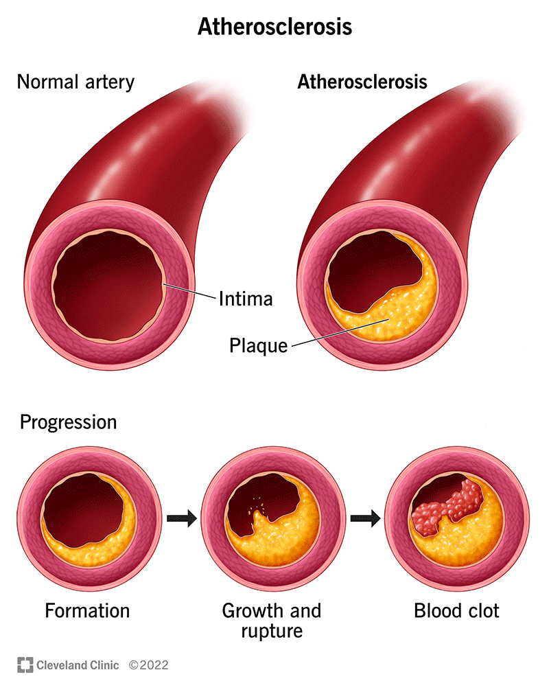 Illustration showing the stages of plaque buildup in your artery.