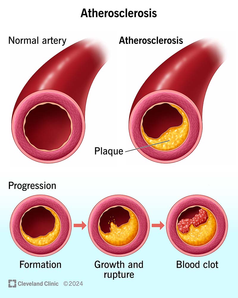 Illustration showing the stages of plaque buildup in your artery.