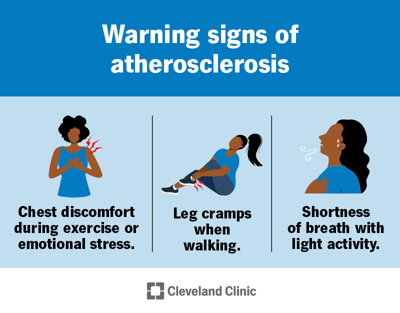 Infographic showing several warning signs of atherosclerosis. They include chest discomfort during exercise or emotional stress, leg cramps while walking and shortness of breath with light activity.