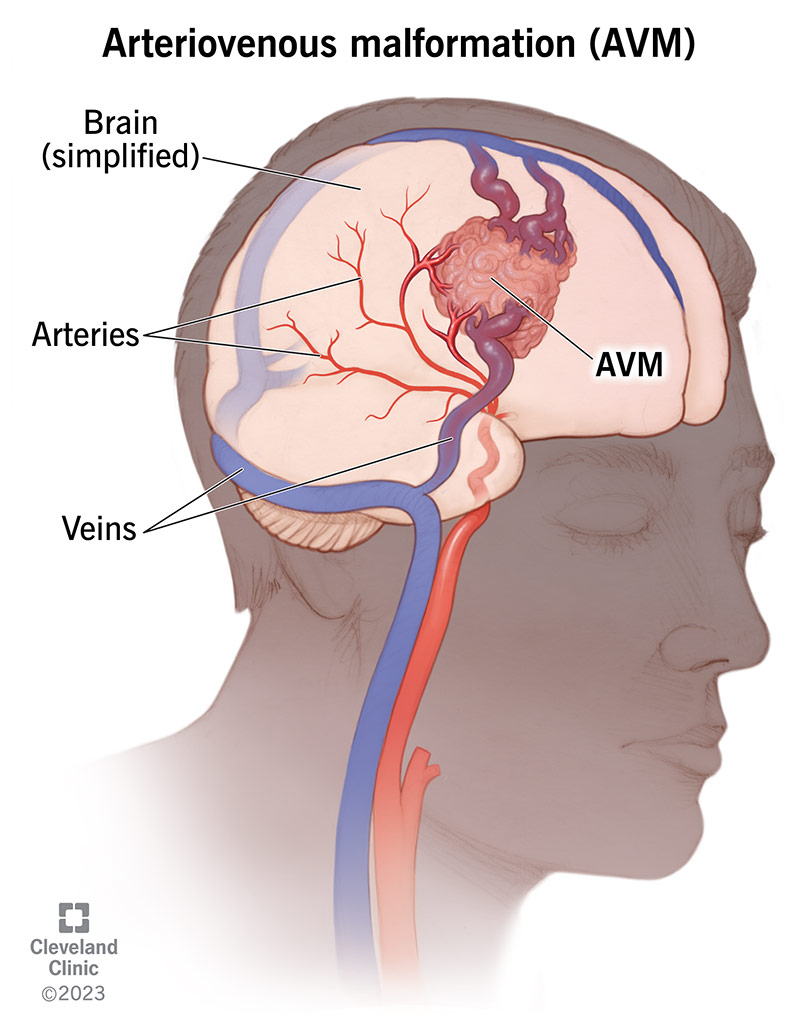 An arteriovenous malformation looks like multiple blood vessels tangled together.