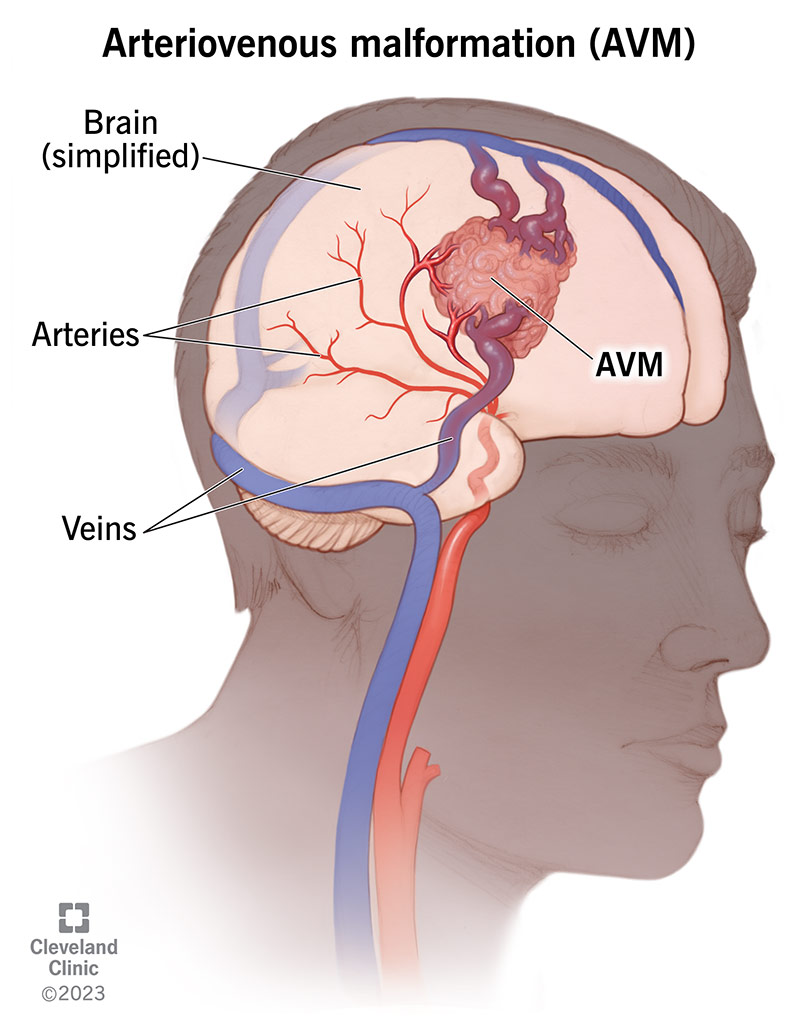 Brain test will warn patients of death risk