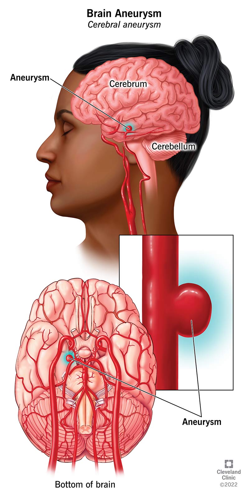 Brain Aneurysm: What It Is, Causes, Symptoms & Treatment