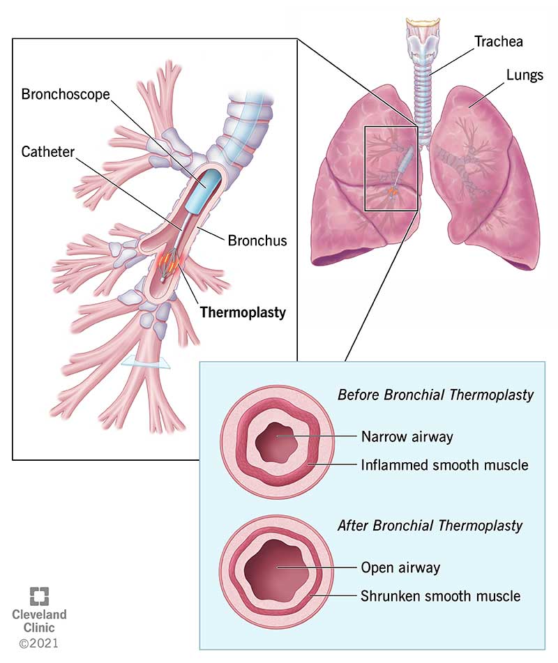 bronchial thermoplasty treatment graphic