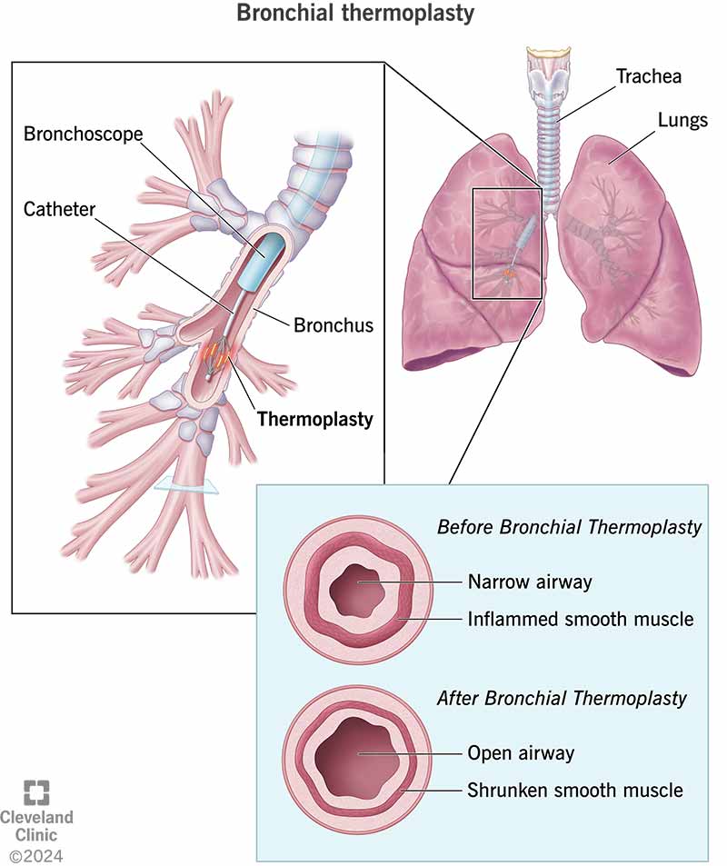 Bronchial Thermoplasty: What It Is, What It Treats & Details