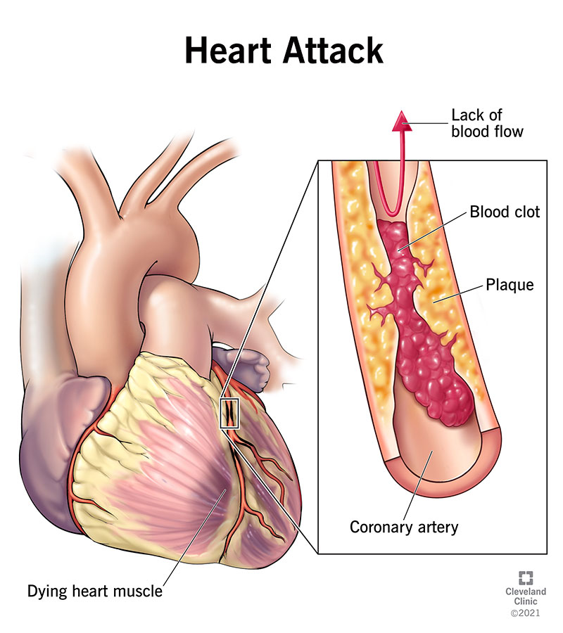 Blocked artery stopping blood flow to the heart during a heart attack.