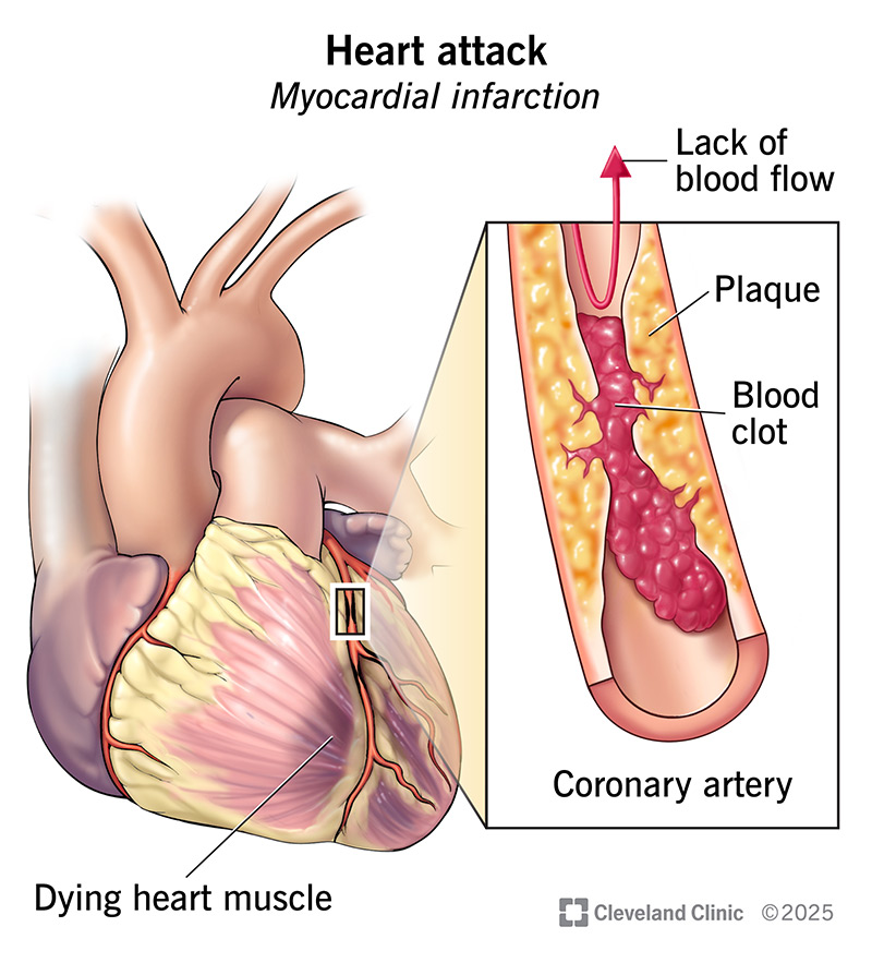 Illustration of plaque blocking blood flow in a coronary artery