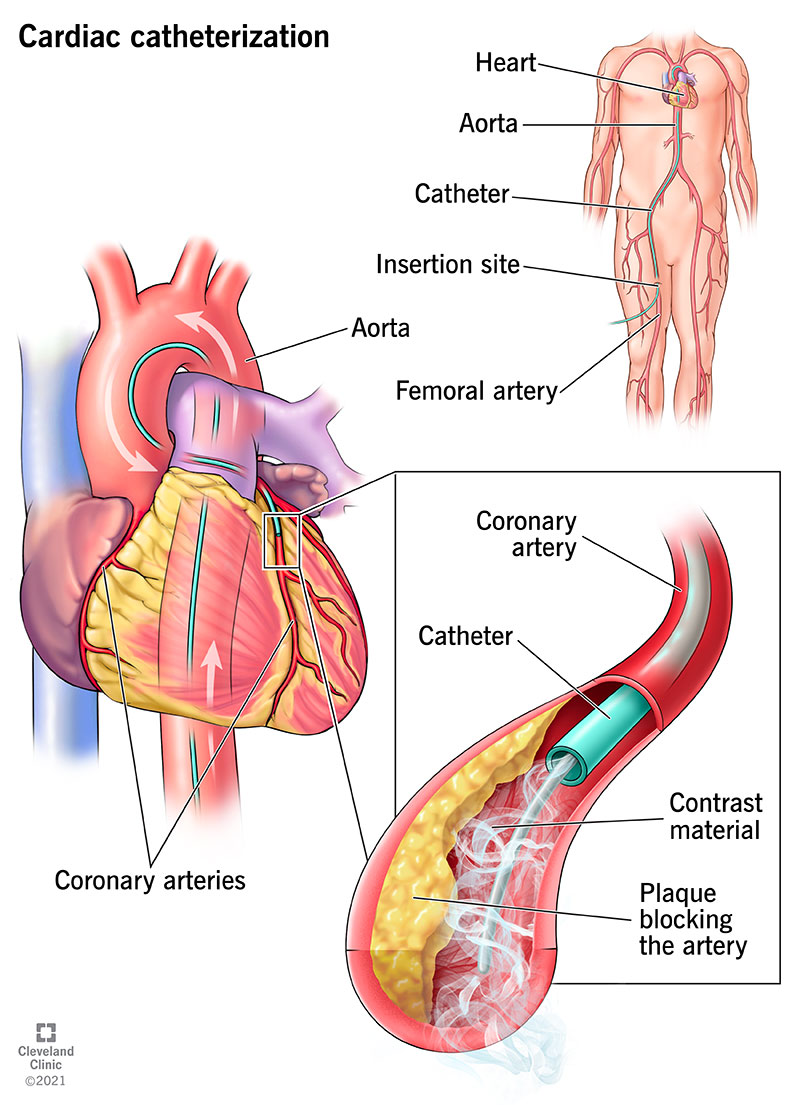 post cardiac catheterization complications