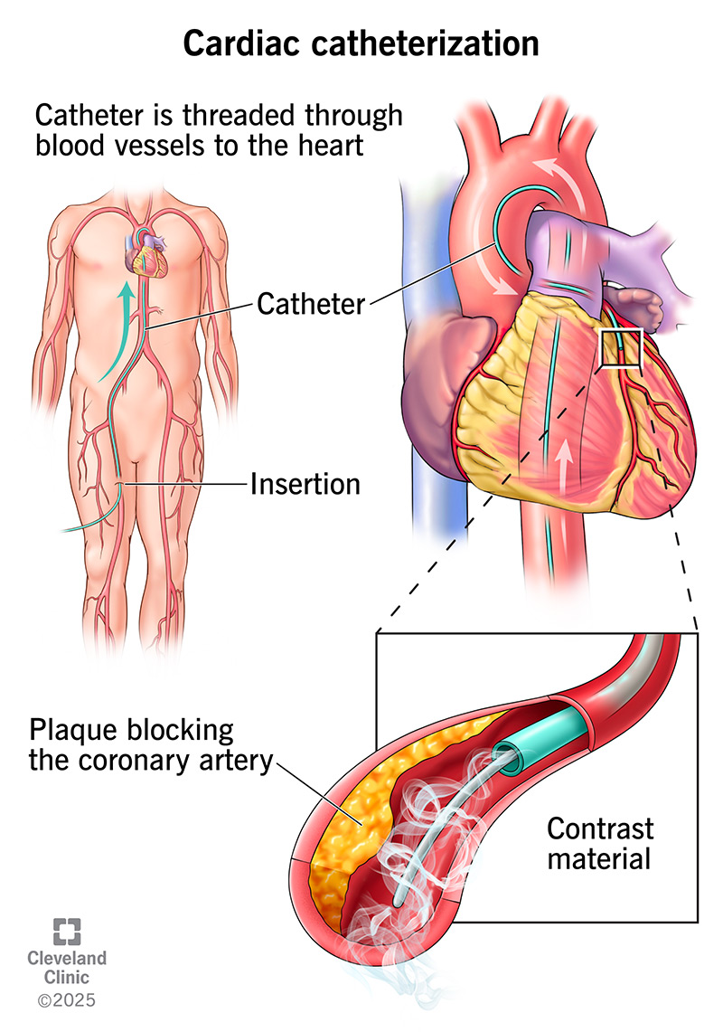 Cardiac catheterization is an invasive procedure to evaluate your heart function.