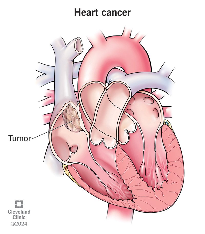 Heart cancer is rare, most often spreading from a nearby organ