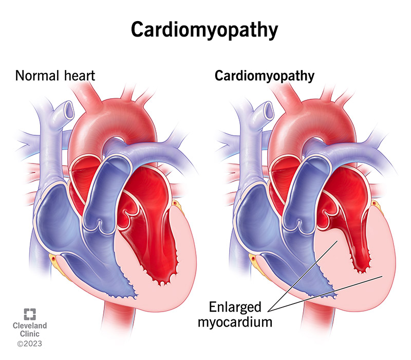A normal heart compared to a heart with cardiomyopathy, which is larger and weaker.