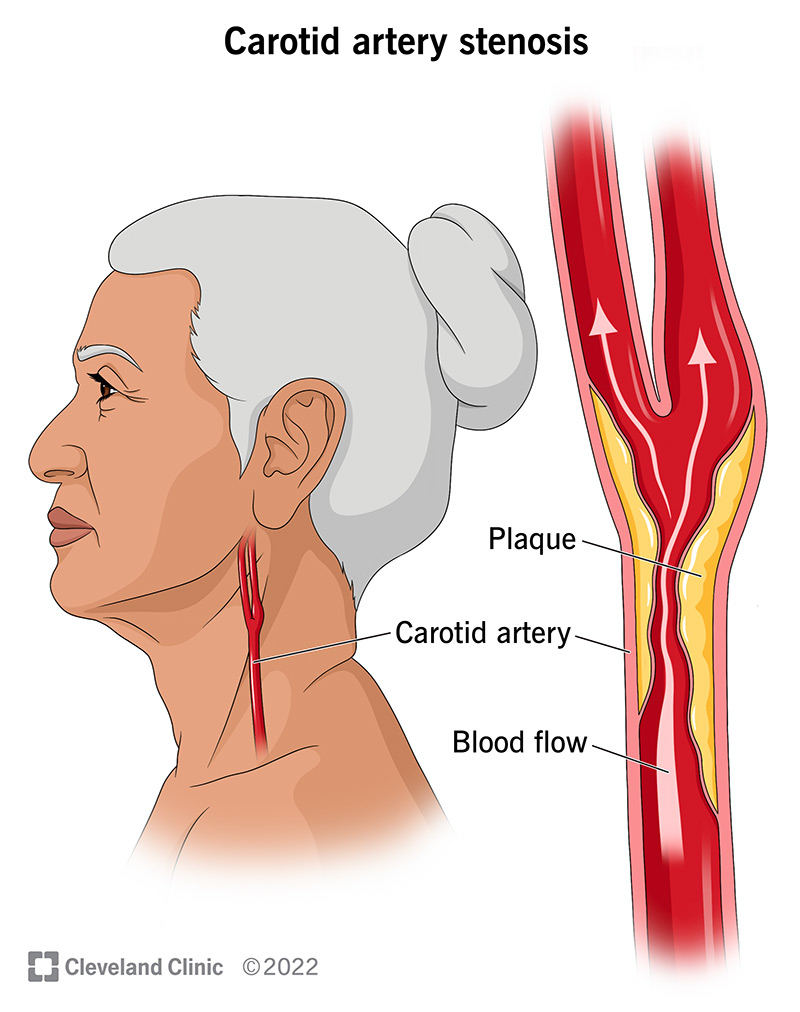 Illustration showing how plaque build-up blocks normal blood flow in carotid artery stenosis.
