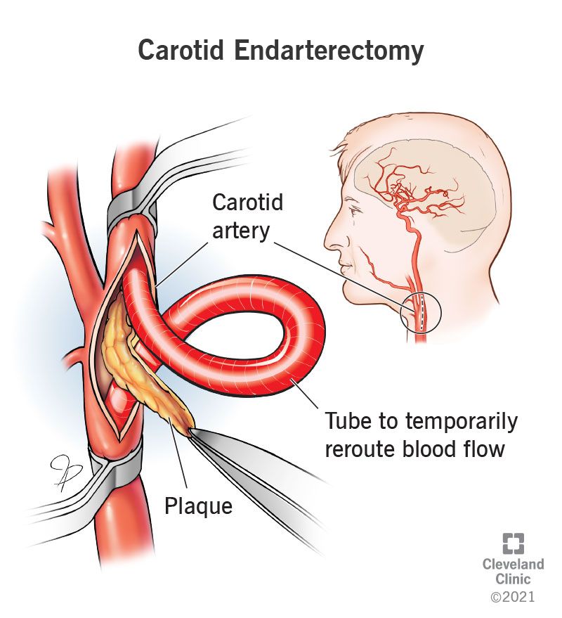 Illustration of plaque removal during carotid endarterectomy.