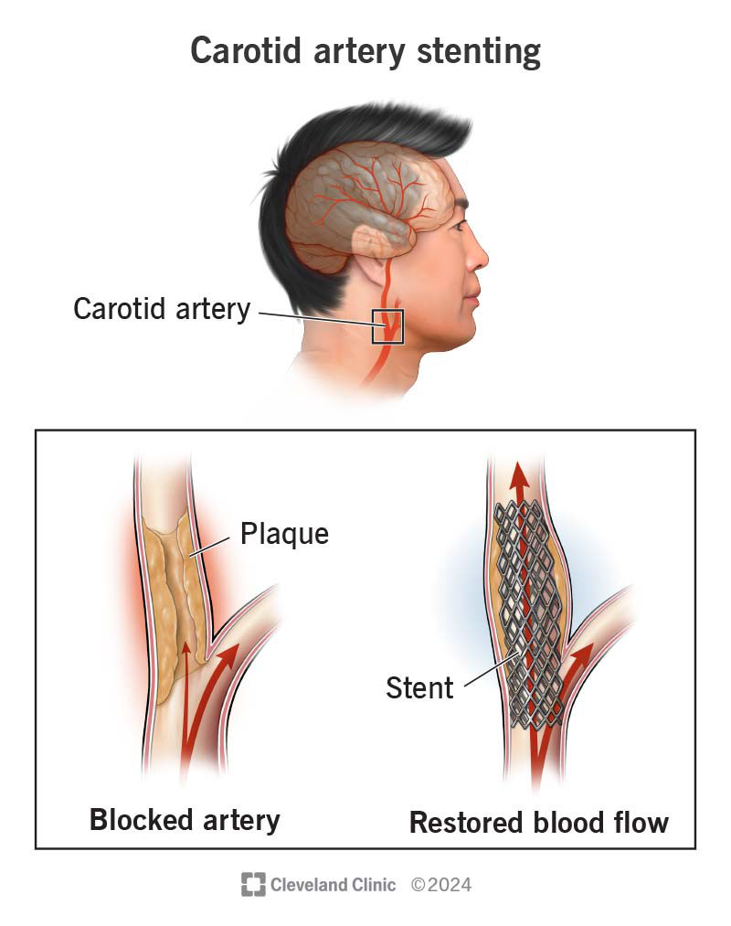 Carotid artery stenting, using a metal tube to expand an artery blockage, restoring blood flow to the brain