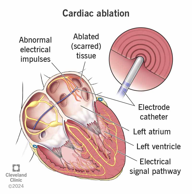 In a cardiac ablation, a provider uses a catheter to create scar tissue that stops abnormal electrical impulses