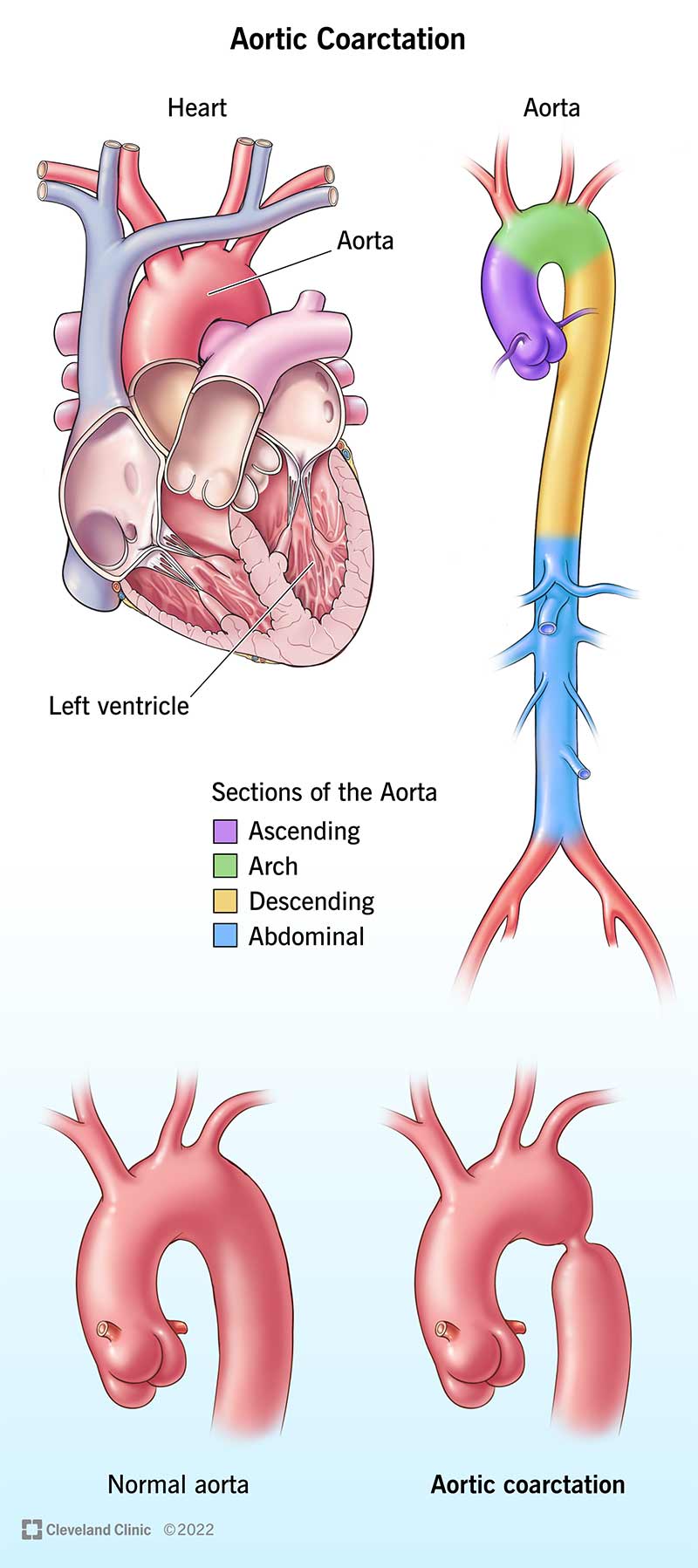 A group of illustrations showing the anatomy of the heart and aorta. Side-by-side pictures show a healthy aorta compared with one that's narrowed.