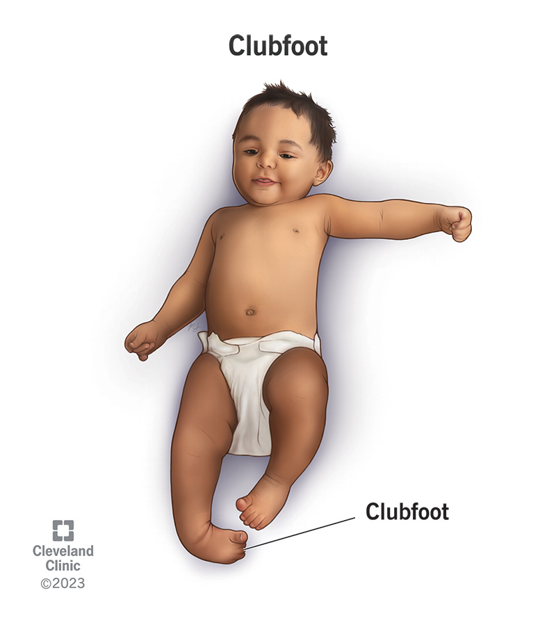 A baby with clubfoot.