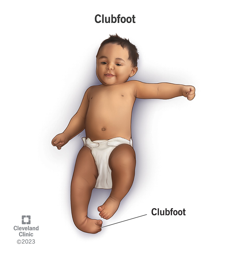 On the cure of club-foot without cutting tendons : and on certain