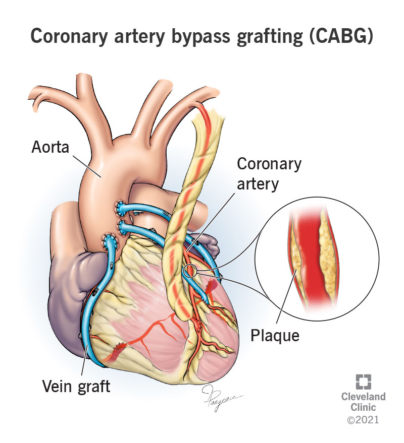 How grafts are attached to the heart for coronary artery bypass surgery.