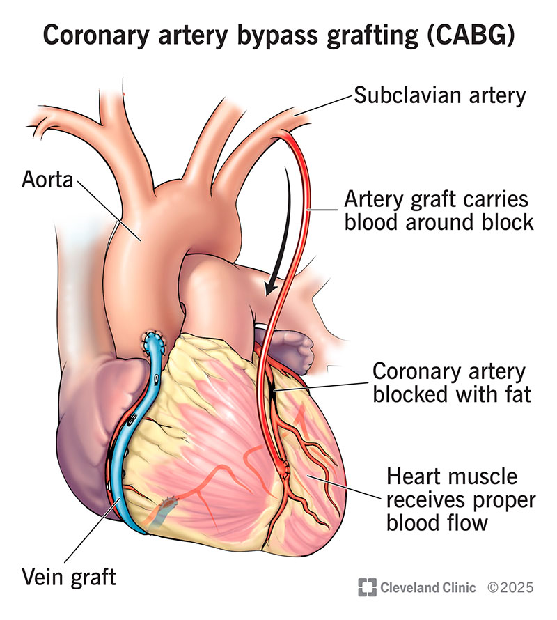 Coronary Artery Bypass Graft CABG Surgery
