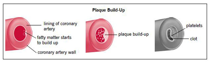 CAD Plaque Buildup