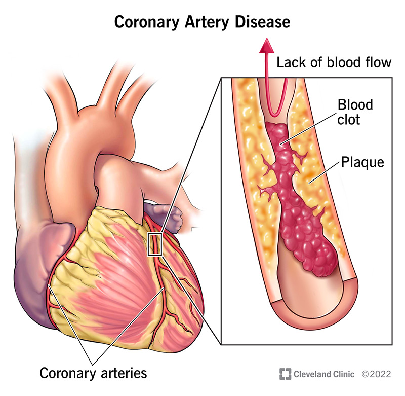 coronary-artery-disease-cad-symptoms-treatment