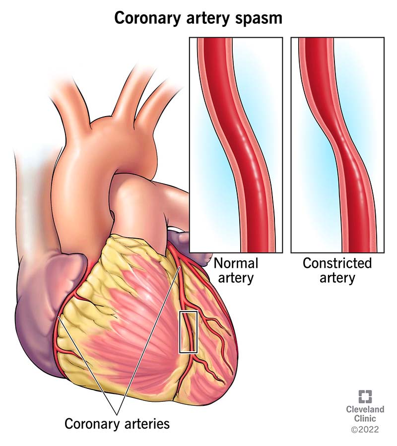 Comparison of normal artery and constricted artery in coronary artery spasm.