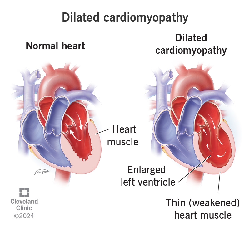 A heart with dilated cardiomyopathy with stretched, thin muscle compared to a healthy heart