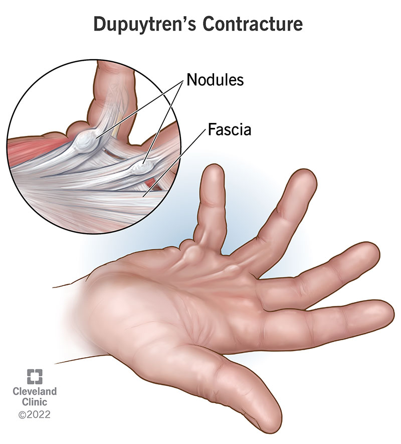 Dupuytren contracture in a right pinkie and ring finger
