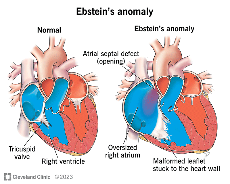 A heart with Ebstein’s anomaly has several issues in the right side of your heart because of a valve issue there.