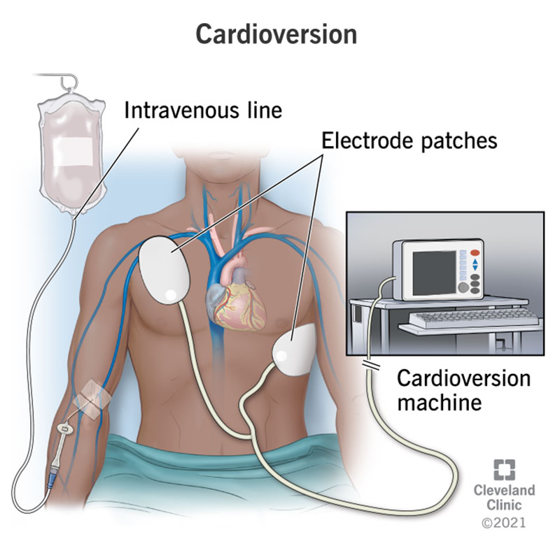 Cardioversion procedure to help return an abnormal heartrate to a normal rhythm.